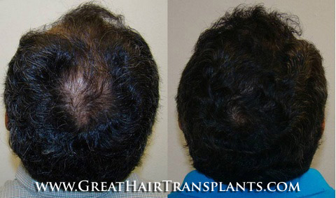 hair transplant surgery