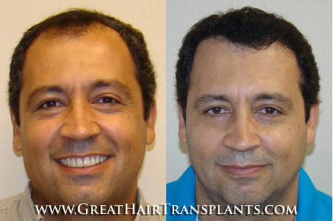 hair restoration