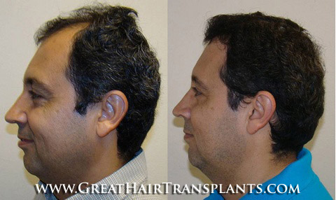 hair restoration