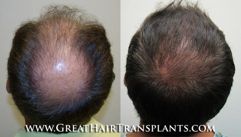 hair restoration