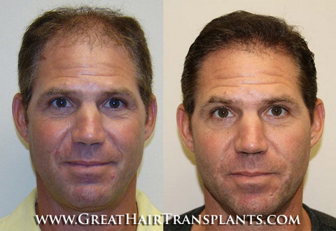 surgical hair restoration