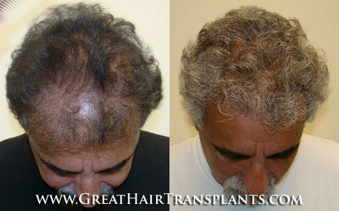 hair grafts