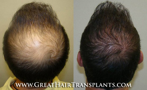 how much does a hair transplant cost