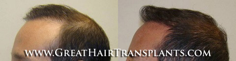 hair transplant