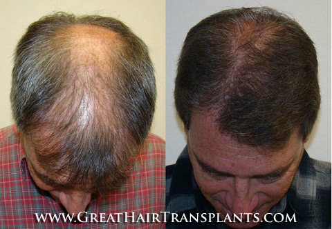 surgical hair restoration