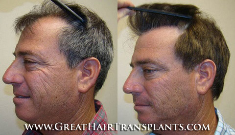 low cost hair transplant