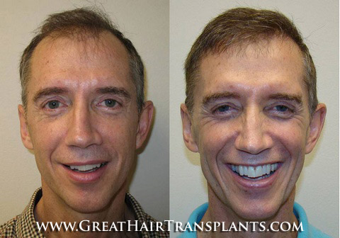 hair transplantation