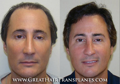 low cost hair transplant