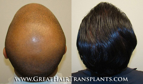 hair transplant surgery