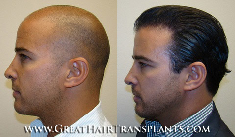 low cost hair transplant