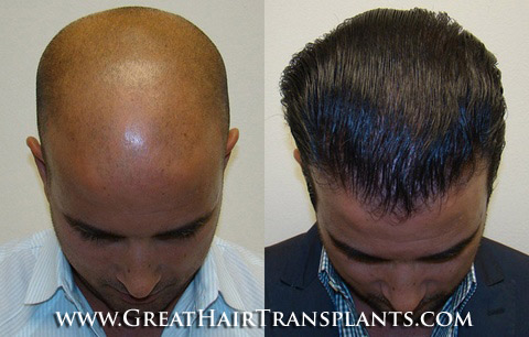 hair loss prevention