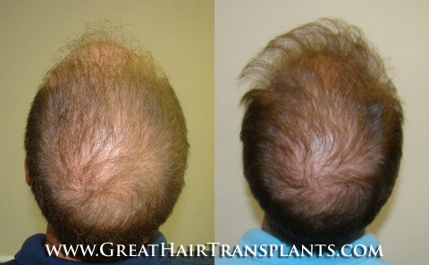 hair transplantation