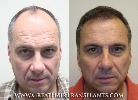 hair restoration