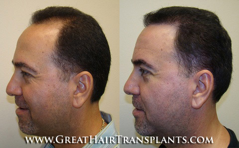 hair transplant surgery