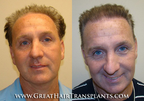 hair transplantation