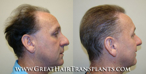 hair transplant clinics