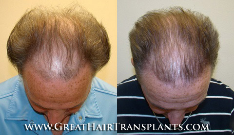 cures for hair loss