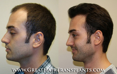 hair transplants cost