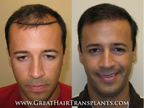 hair transplant clinics