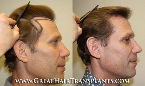 hair transplant surgery