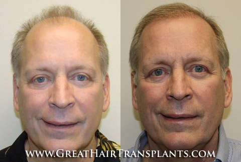 hair transplant