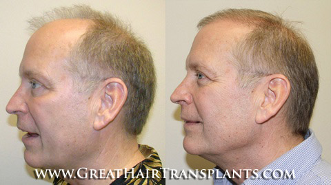 low cost hair transplant